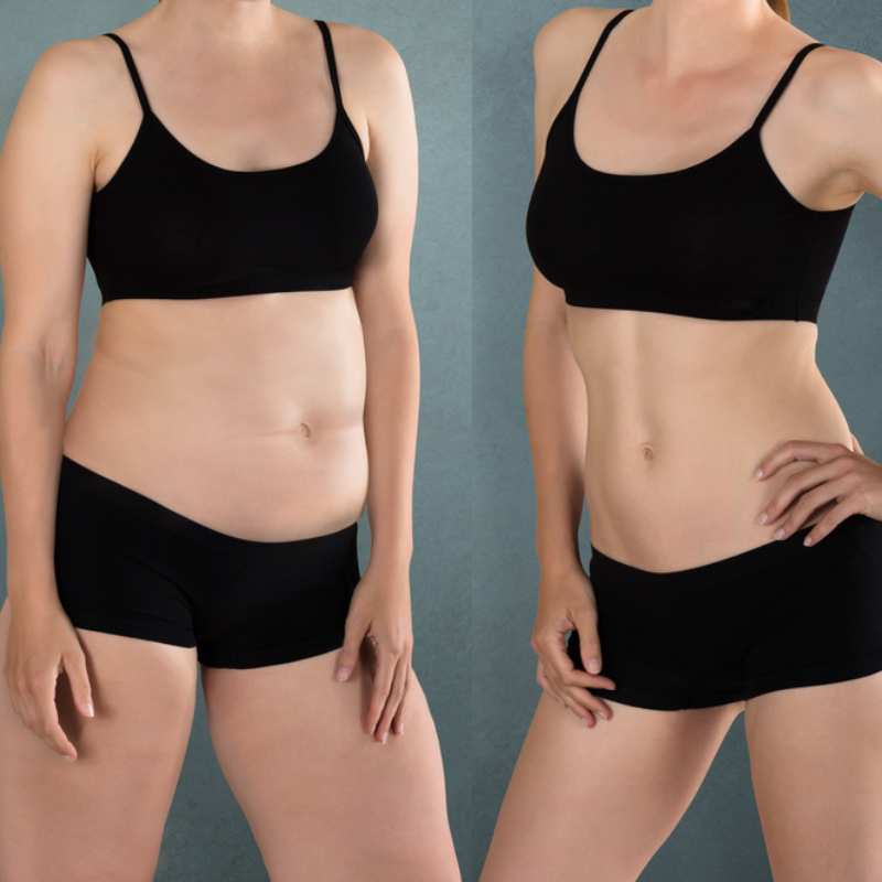 Does Fat Freezing at Home Work? DIY Devices vs Professional Cryolipolysis 2 before and after Cryolipolysis Rochester