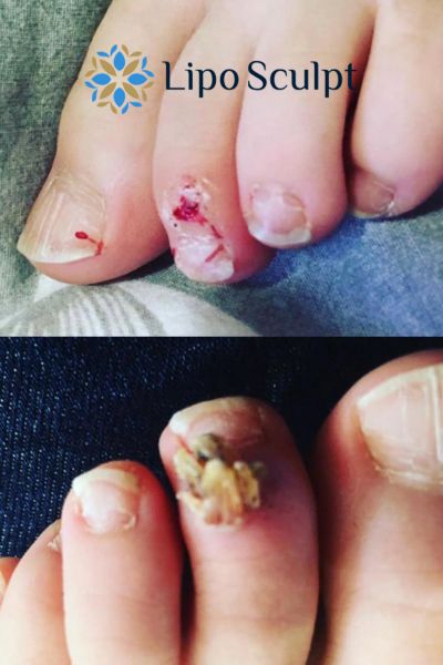 Wart removal customer results from Lipo Sculpt Rochester